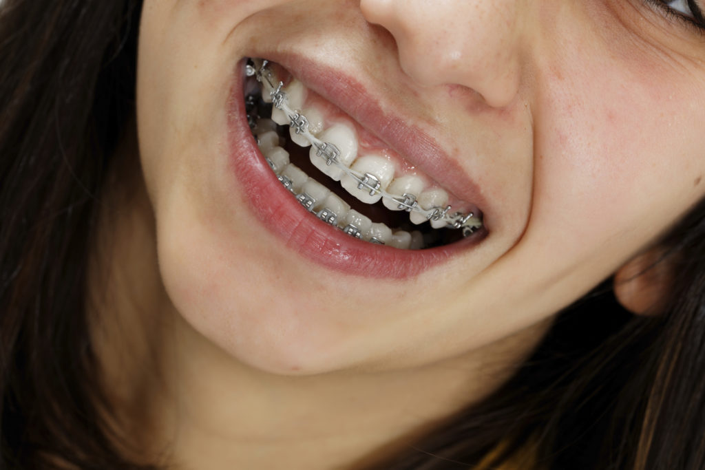 Braces specialist in Ahmedabad