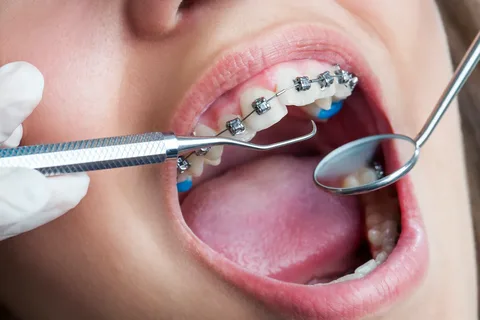 Orthodontic Treatment Clinics in Ahmedabad