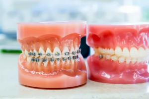 Best Orthodontic treatment in Ahmedabad