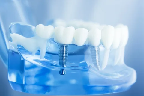 dental implants in ahmedabad