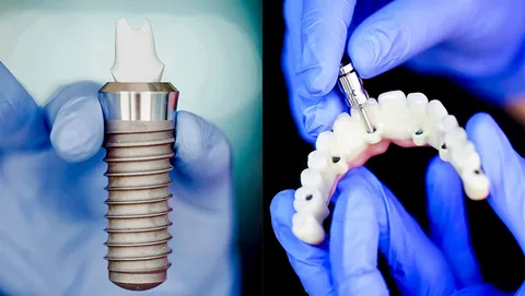 dental implant in Ahmedabad