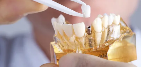 what dental implant