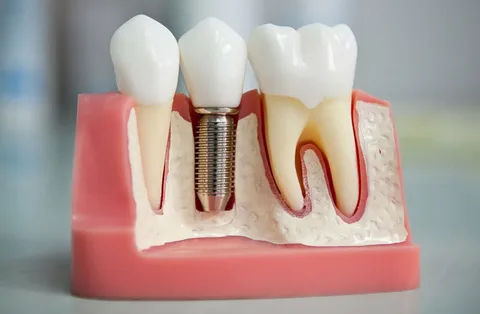 Choosing a dental implant in Bodakdev